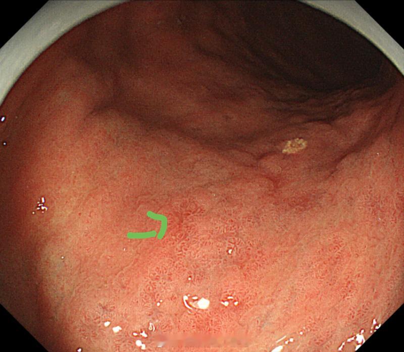 找肿瘤就是一堆斑驳粗糙的萎缩黏膜中看到认识的早期肿瘤，图示一个我们南院护士长老爸