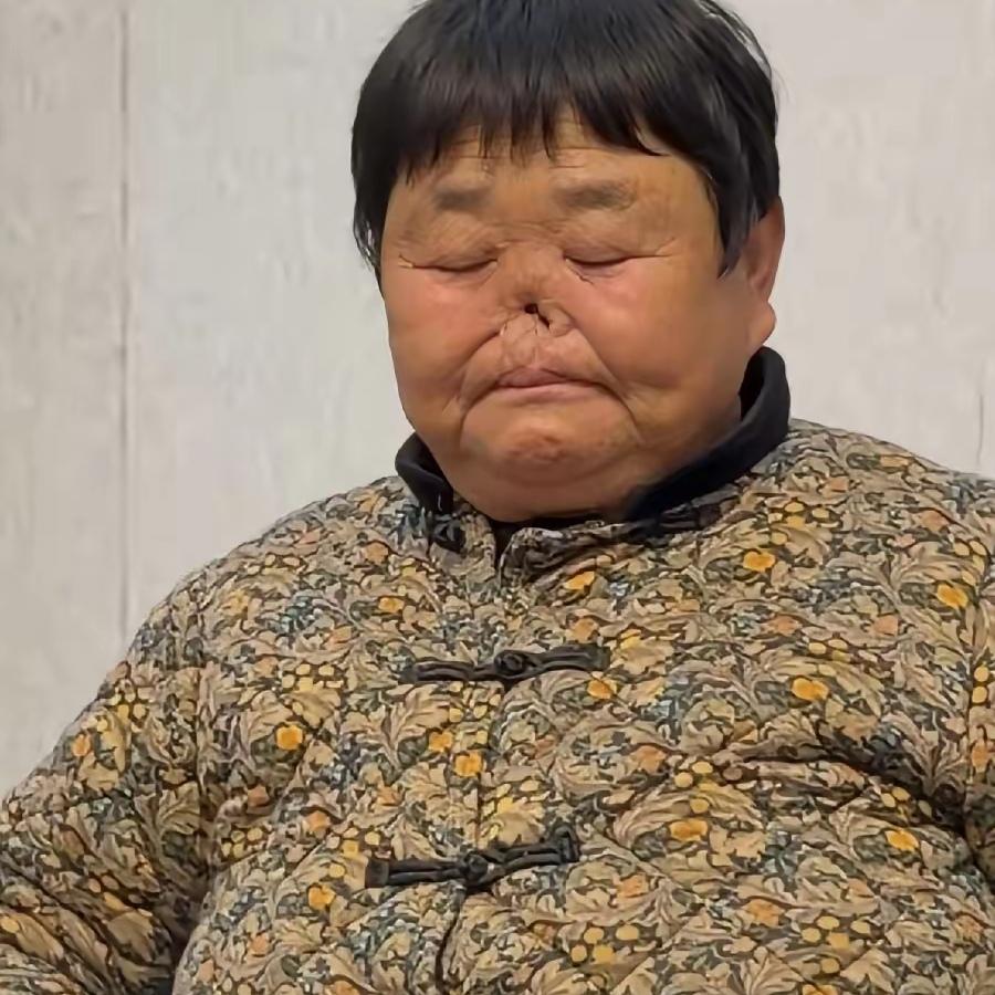 你能想象吗？有位妈妈在婴儿时期，遭遇了极其恐怖的一幕——鼻子被老鼠全部咬掉！这听