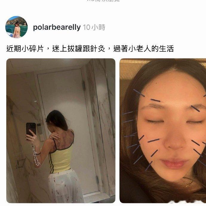 小S大女儿晒拔火罐背部 小S大女儿晒针灸拔罐日常，这很小老人了哈哈哈  小S大女
