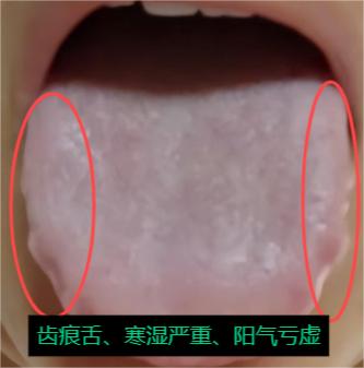 遇上这样的舌头就不用犹豫了，直接附子、肉桂去大力补阳就对了！

主诉：蛟龙不起、