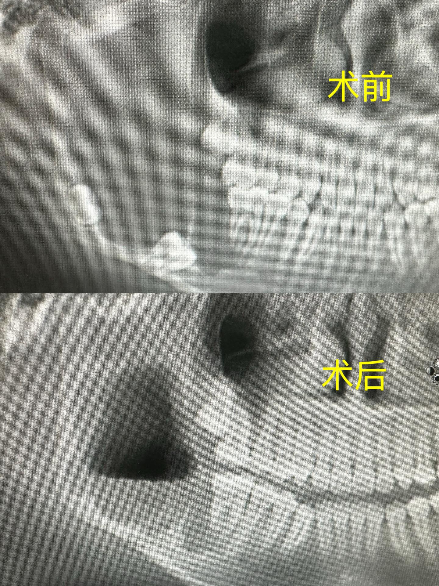 颌骨病变手术。门诊局麻下手术，希望有个好的恢复。
