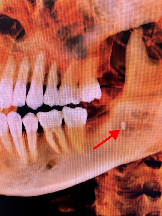 你的牙医拔牙后给你留下的惊喜😏