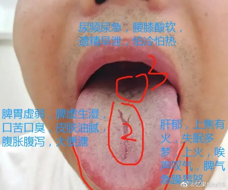 粉丝舌苔分析，上热下寒，肝郁 1、舌尖红，舌两侧红：说明上焦有火，还有肝郁，所以