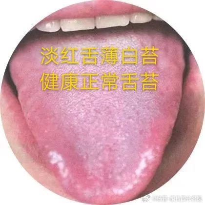 《健康舌象》淡红舌，薄白苔健康人的舌象标准为淡红舌、薄白苔。舌体（舌质）：颜色淡