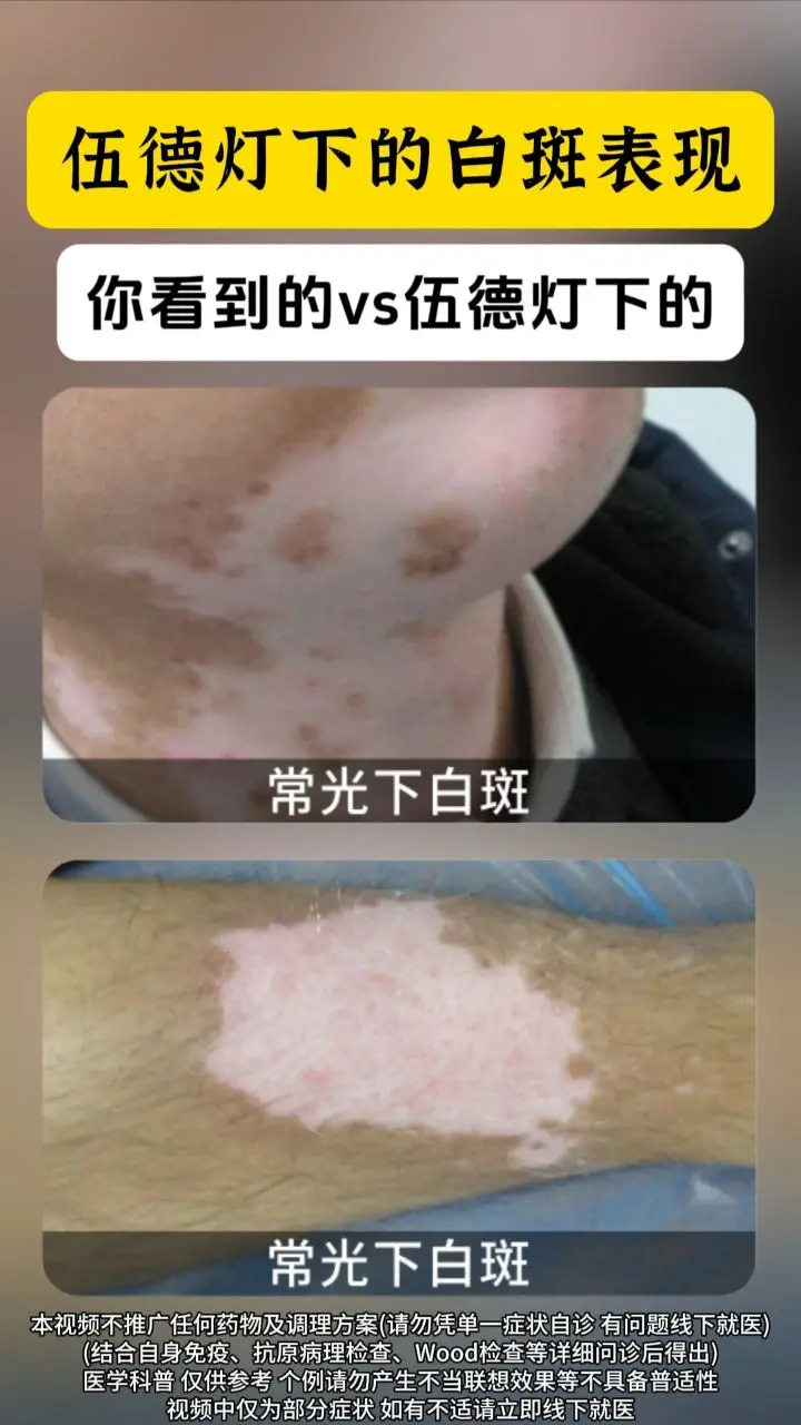 医学科普 白癜风 白斑 硬核健康科普行动  知识分享