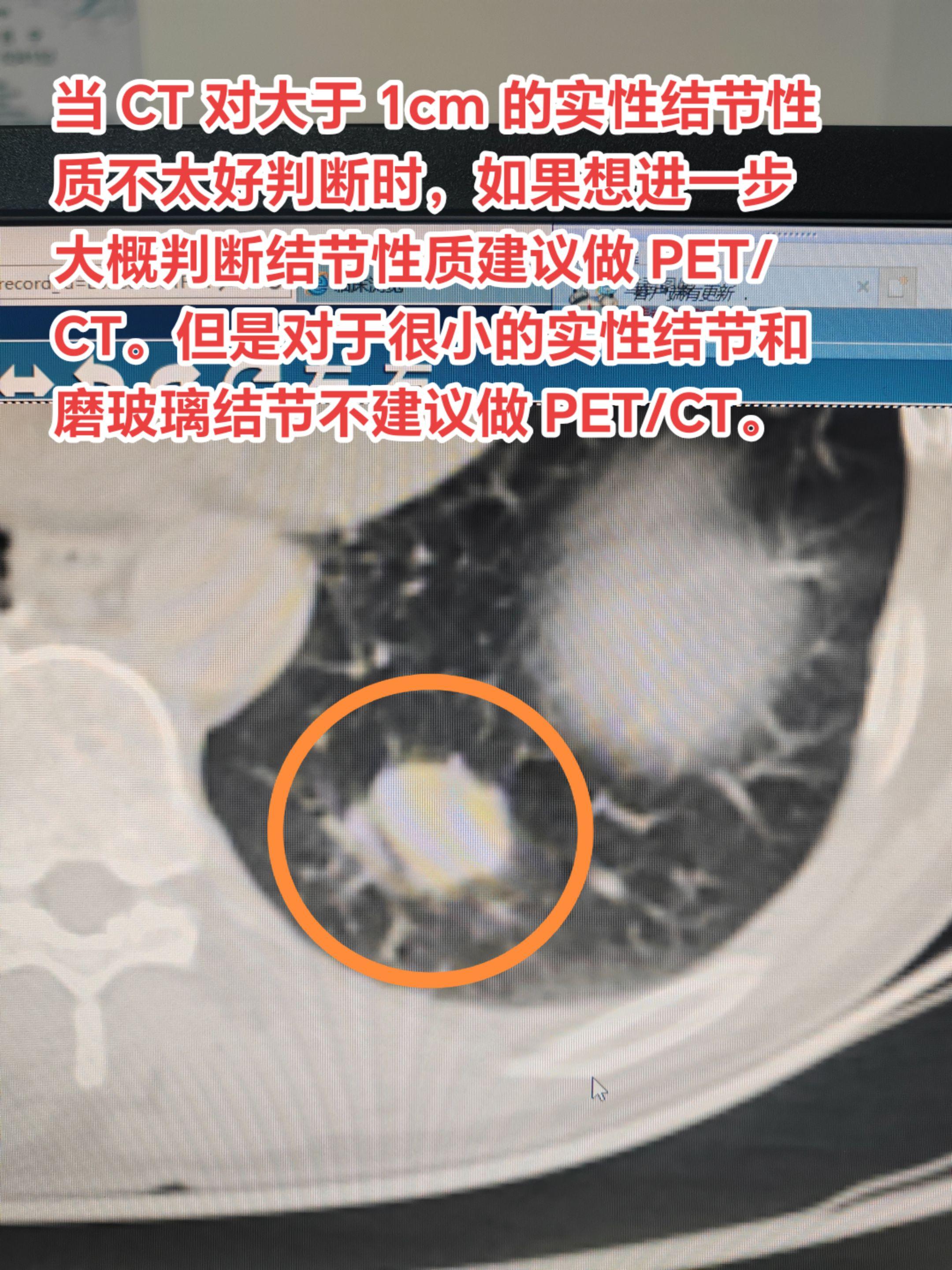 实性肺结节如何准确判断良恶性。当 CT 对大于 1cm 的实性结节性质...