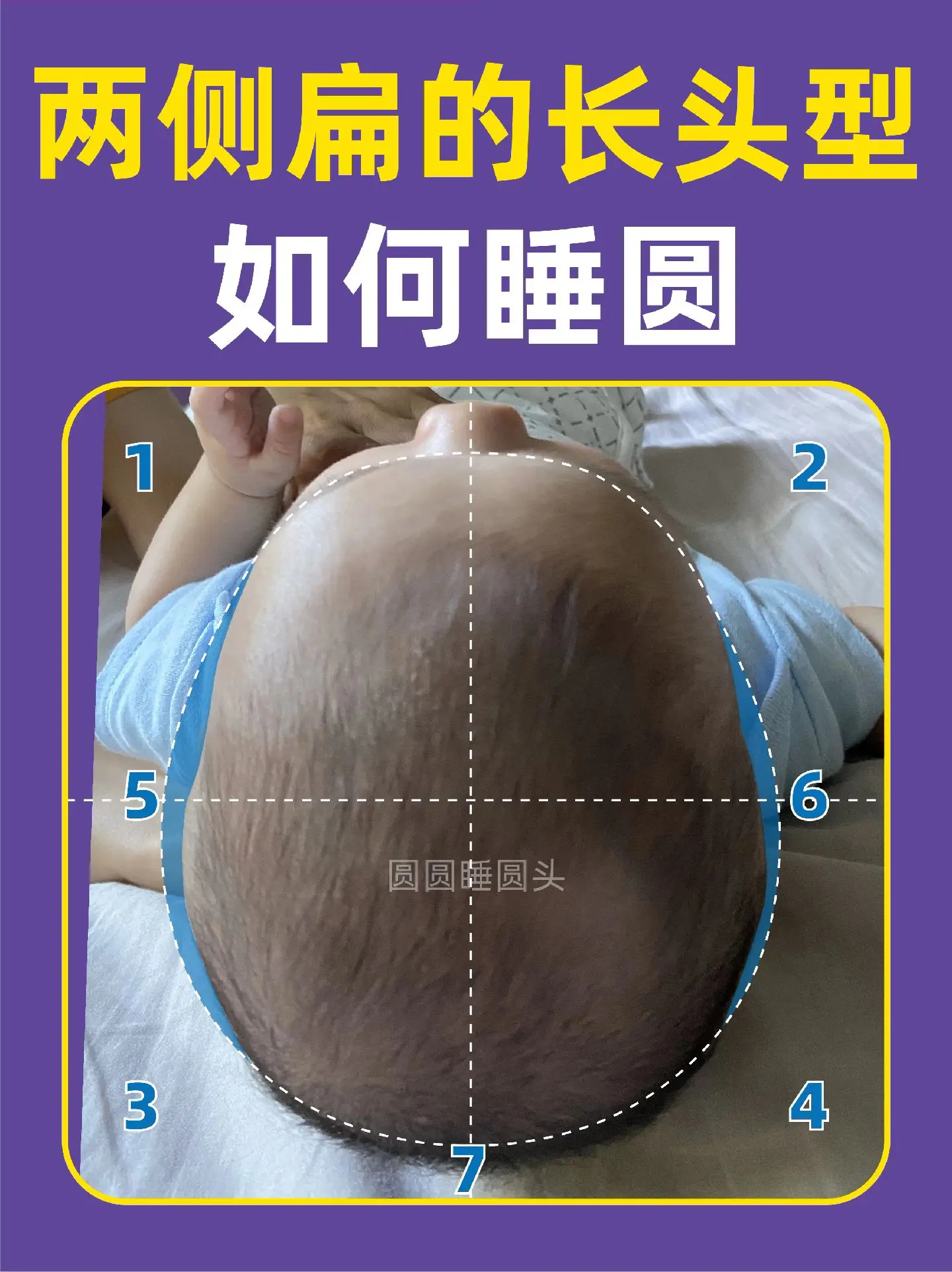 宝宝头型|长尖头如何睡圆头✅真实案例分享。