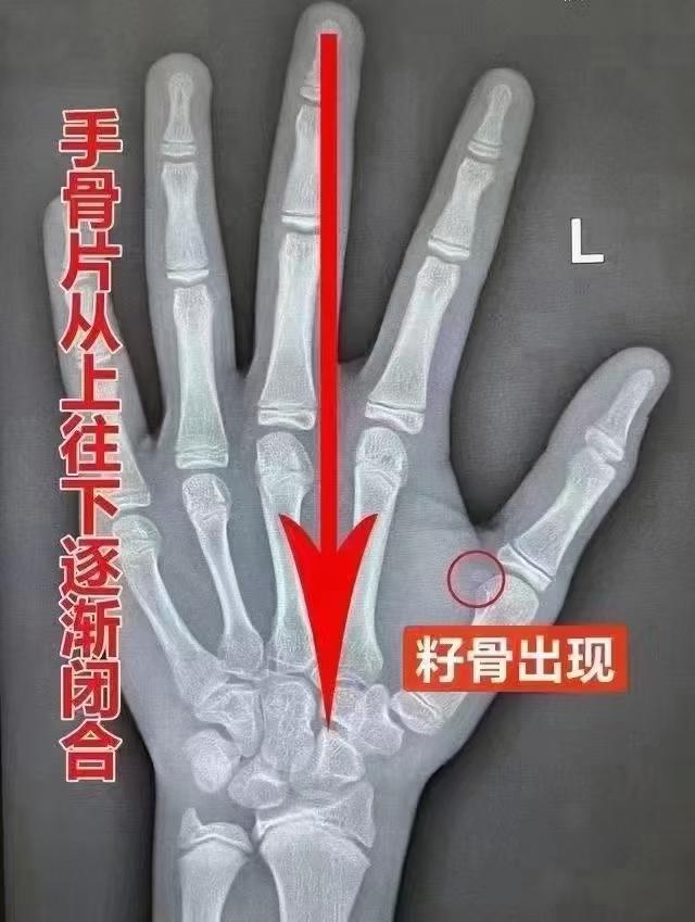 🩸最近大骨龄的孩子特别多

接诊的这个女孩，籽骨都已经很大了；

生长空间不多