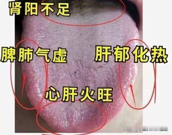 这种肝郁脾虚，肾虚，上热下寒，五毒俱全的舌头，调理搭配很关键，不能只管补！

遇