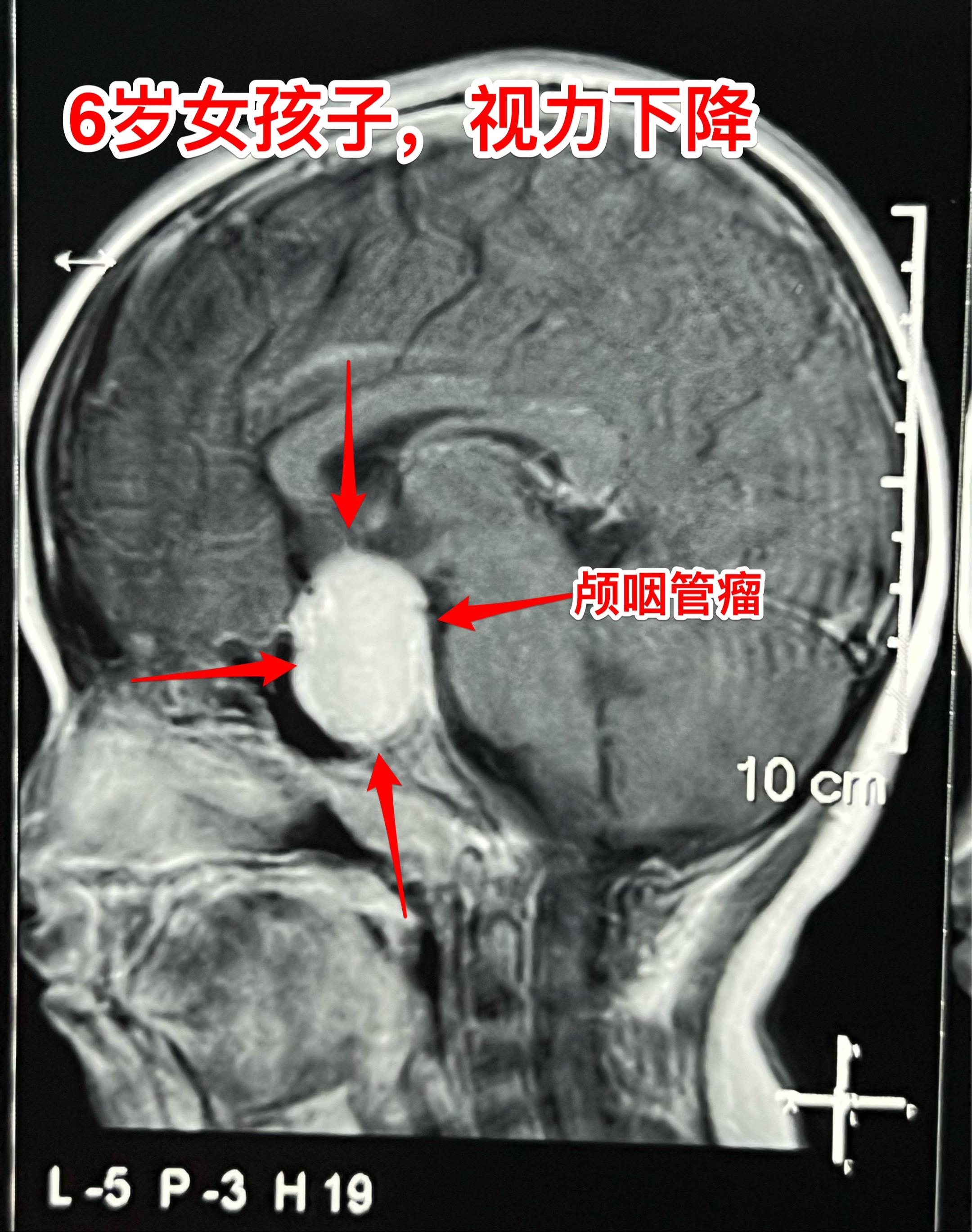 小学生的视力家长一定要关注。小学生因岁数小，对视力下降很可能并不知道表...