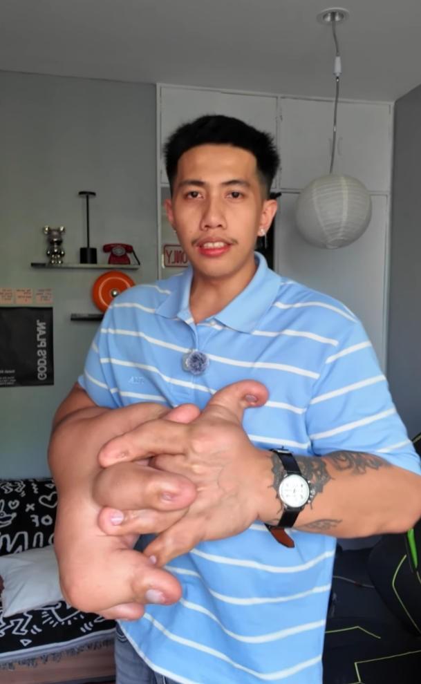 菲律宾男子患上罕见巨指症，双手重达18斤，外形看着触目惊心！

第一眼看到这双手