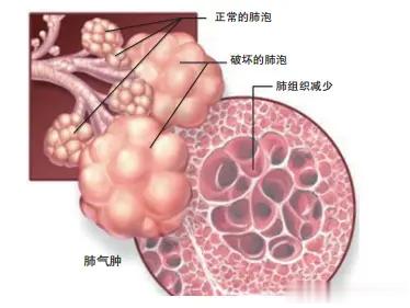 肺气肿生活中要注意的7件事：1.坚决戒烟，当然二手烟和三手烟也尽量避免。2.避免