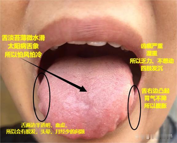 粉丝舌诊实战分享
齿痕——湿重
舌边鼓胀——气机不畅
舌质红，苔薄白—主表证
现