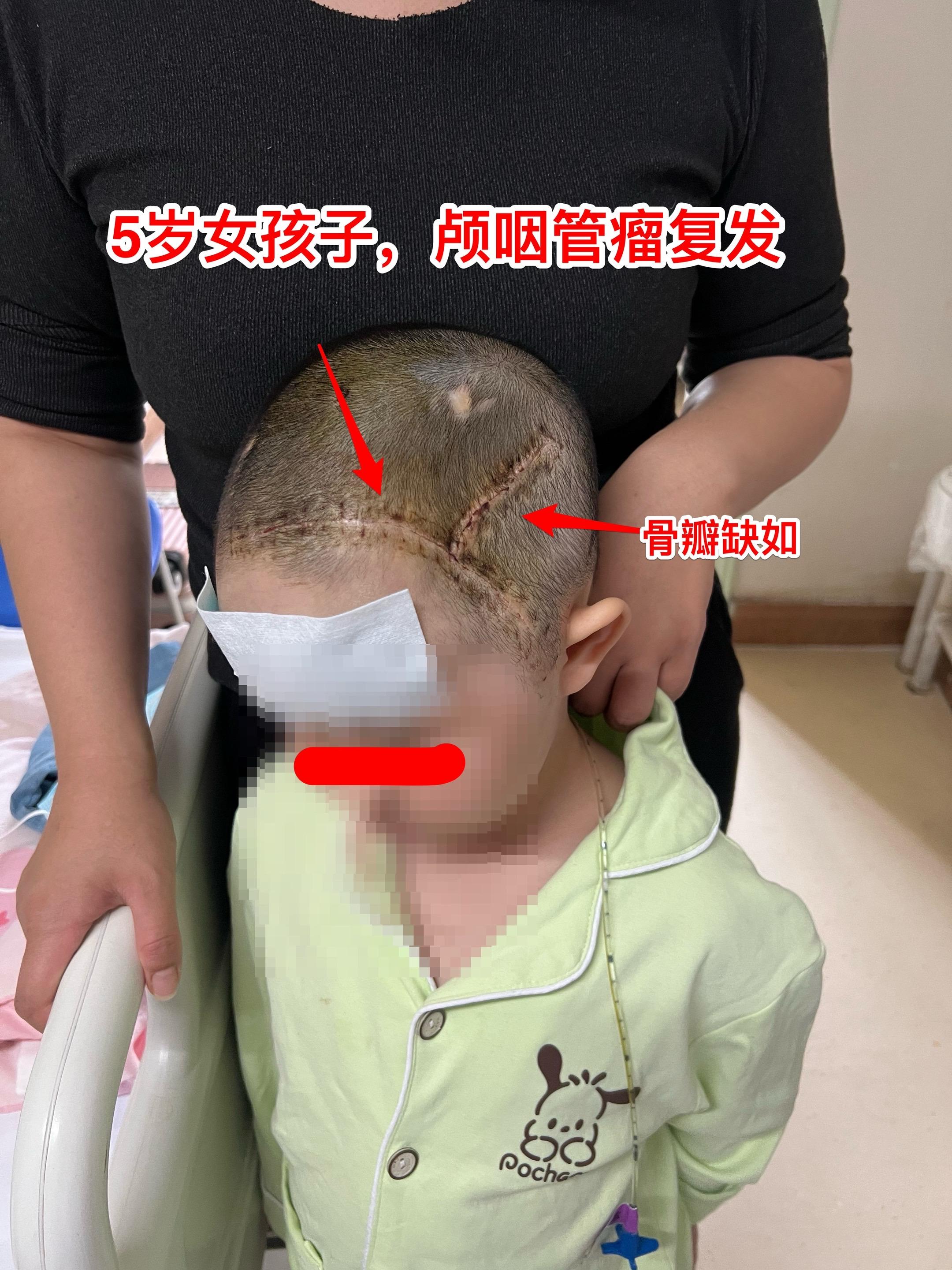 5岁湖北女孩子，第二次颅咽管瘤手术。外院第一次手术后出现左侧大脑半球的...