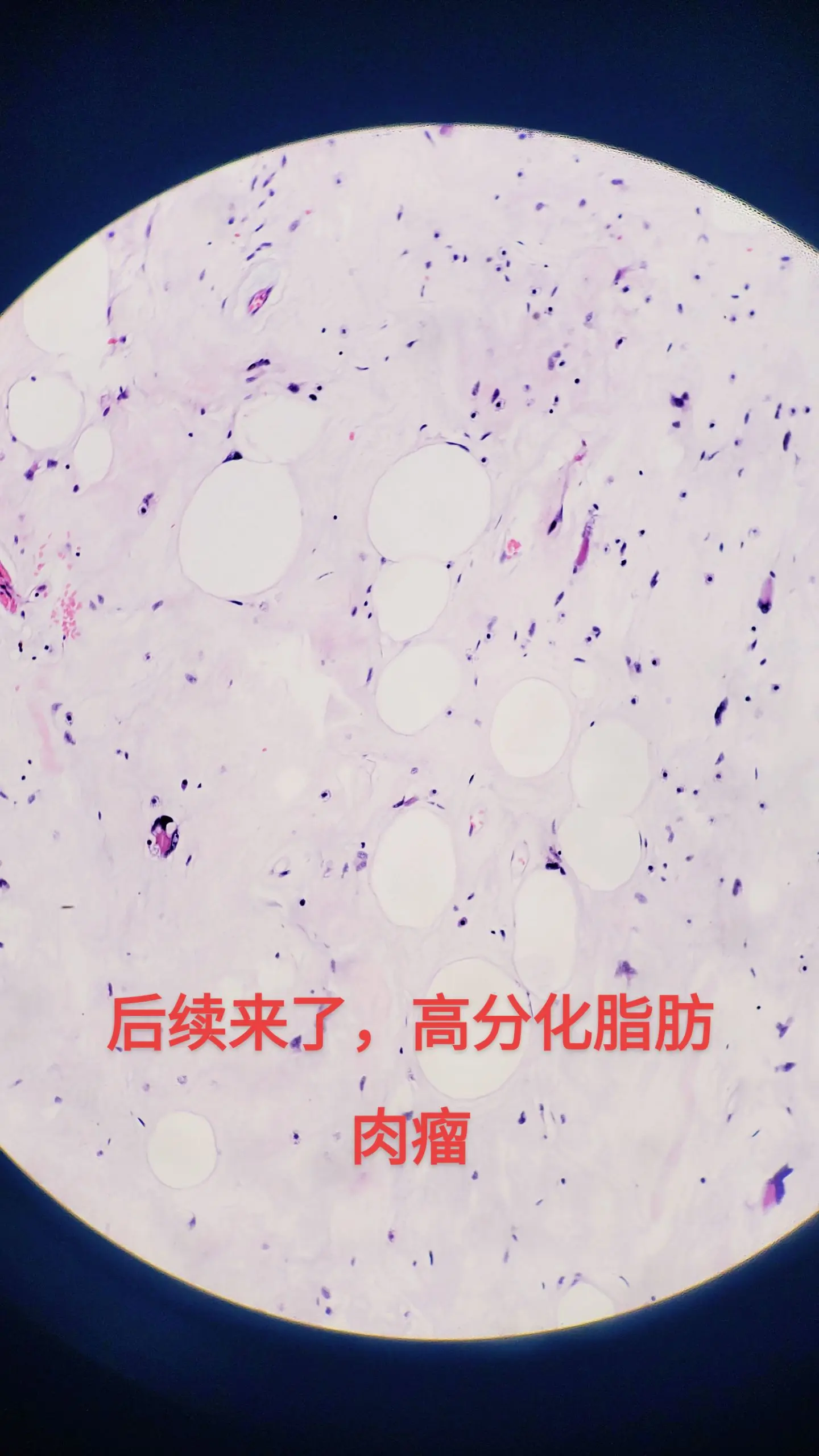 高分化脂肪肉瘤