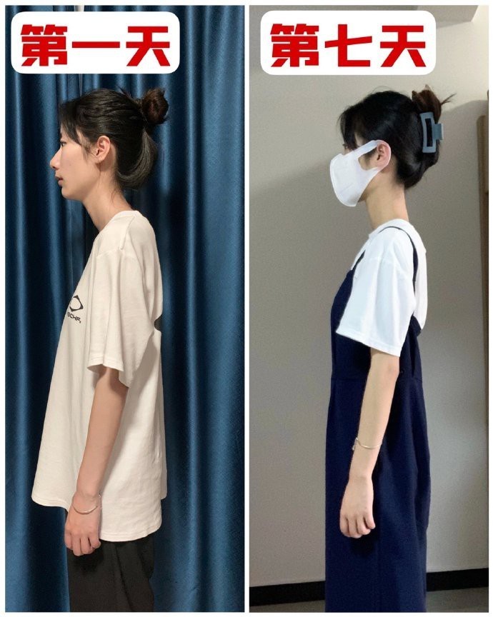 试过了！这个动作真的可以改善脖子前倾👍 ​​​