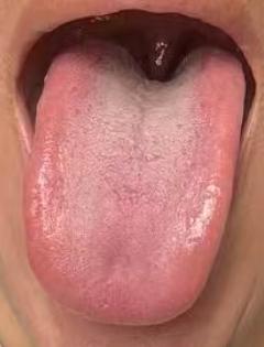 跳出滋阴固有思路，以祛湿调治血糖





很多人认为血糖高就是消渴，就是内热，