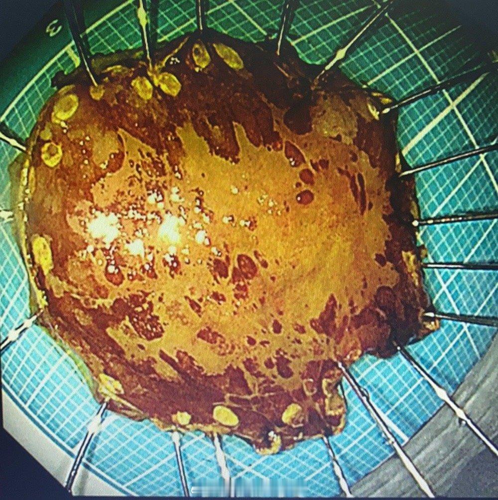 晚上刚结束的金华来的案例，喝酒40多年，斑状食管，多发食管早期癌（图片里面黄色部