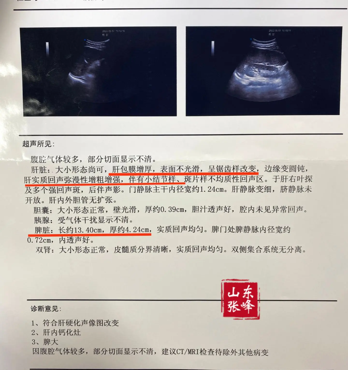 肝脏彩超若出现这4点，警惕肝硬化！1、肝包膜增厚，表面欠光滑，警惕肝硬...