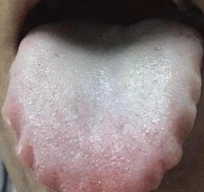 敲黑板！舌头两边像包的饺子一样，你是不是也认为这是脾虚湿气重导致的？？
    