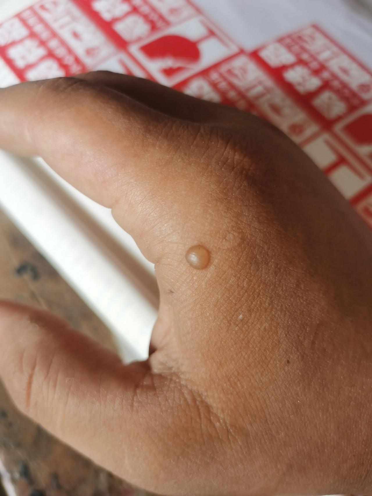 昨天中午为了吃包谷面疙瘩，手上不小心烫了一个水泡。不过，想想也是值得，好吃的东西