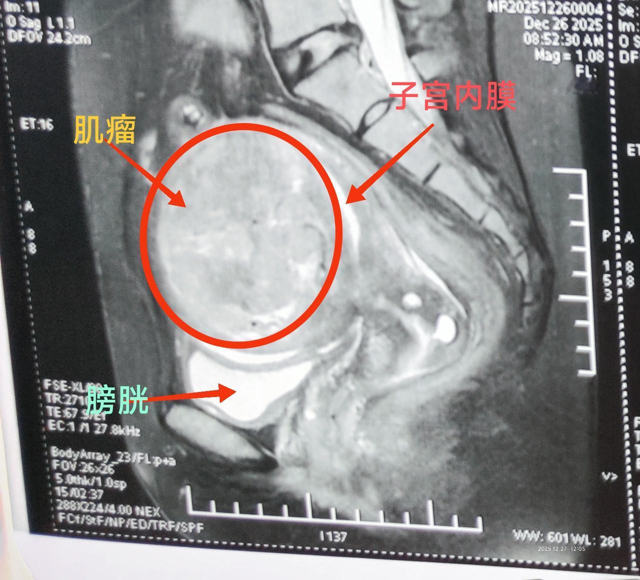 这是我们海扶刀治疗的一名子宫肌瘤患者，病人来自安徽，患者发现肌瘤多年，但是由于合