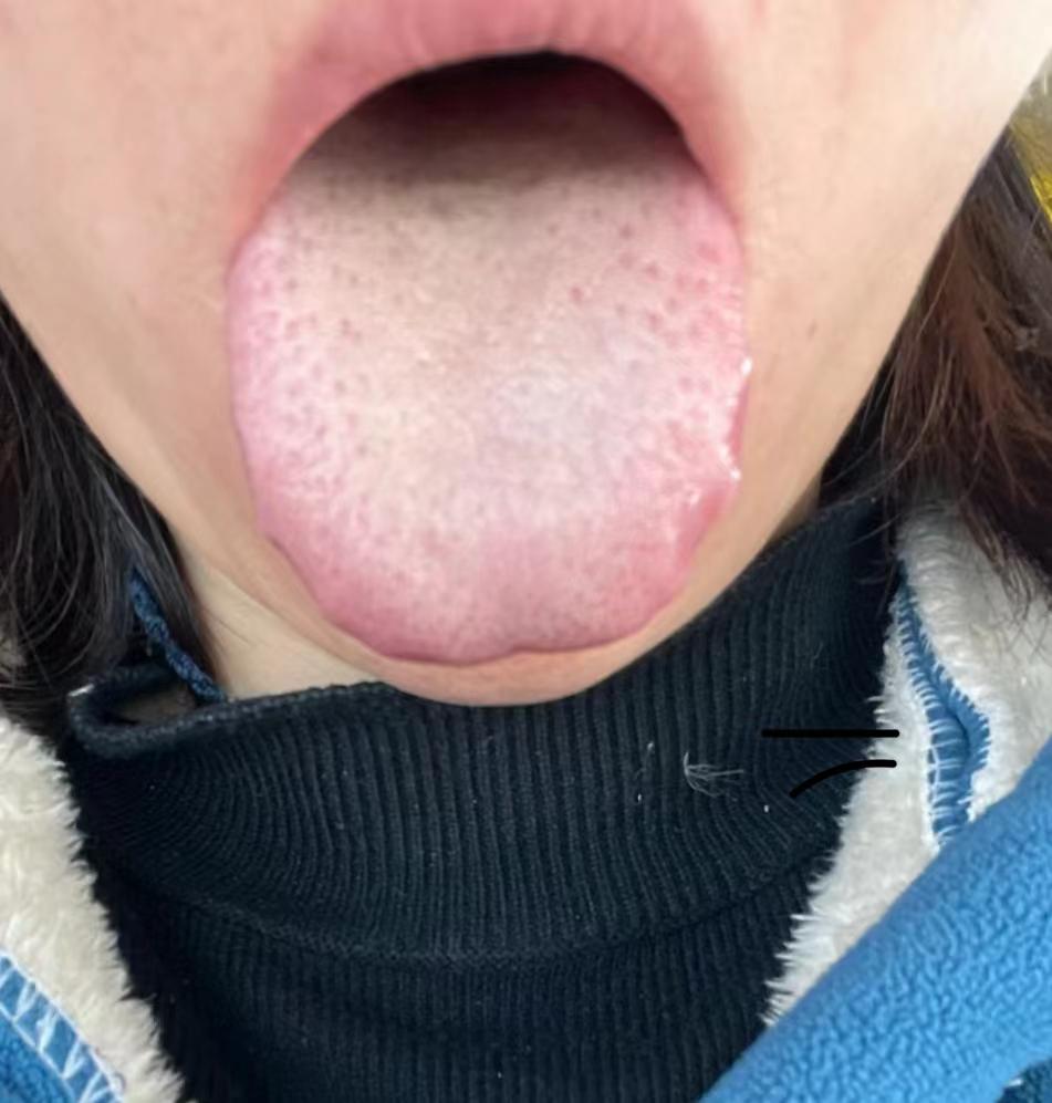碰见这种舌头说白了，是你自己造出来的[灵光一闪]
晚上喜欢熬夜，经常吃辛辣刺激的
