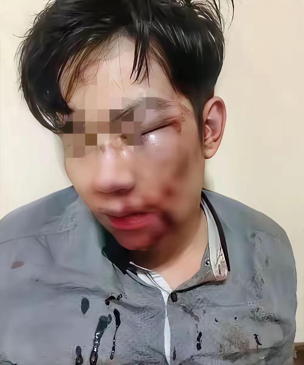 因为中秋节远嫁的妻子回娘家的时候买的礼物有的多，男子就把妻子打的骨折住了院。妻子