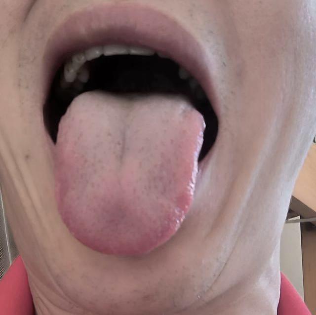 很多人一虚就补，反而容易上火，这种舌象就是最好的例子[思考]

患者主诉：睡眠差
