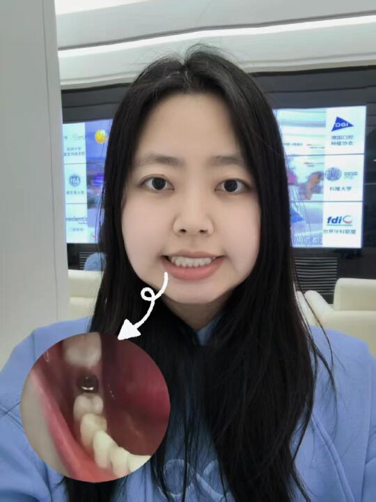 能看出来我哪颗牙是种的么?
