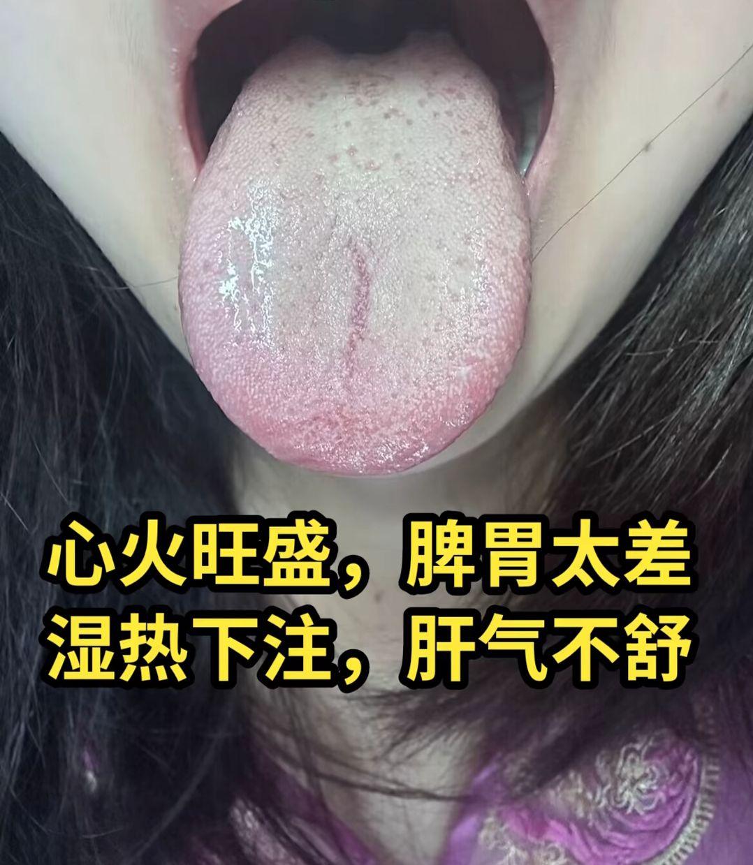 今日舌战：心火旺 湿气重 下焦湿热  肾精不足