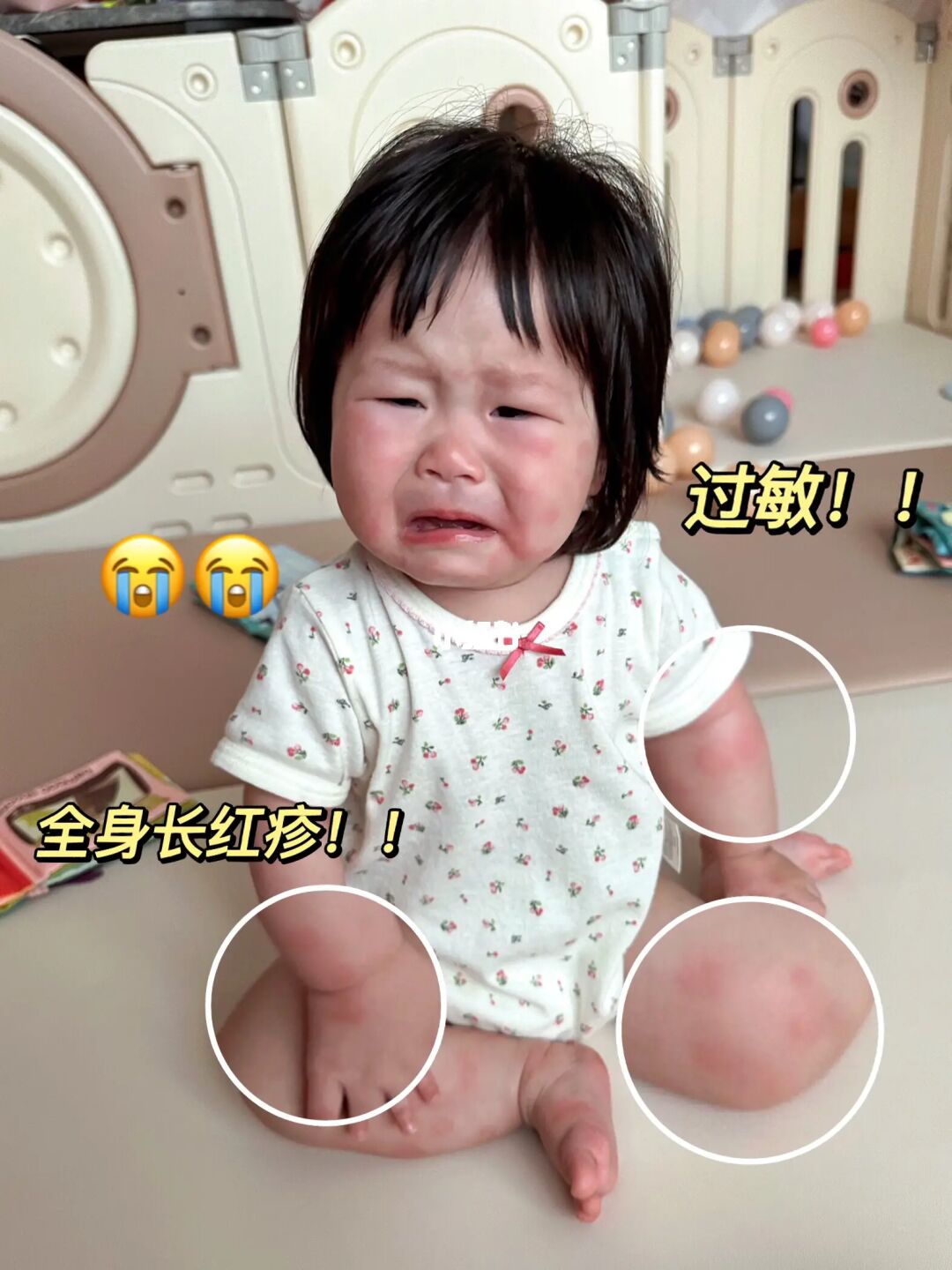 宝宝过敏怎么办？真的操碎老母亲的心