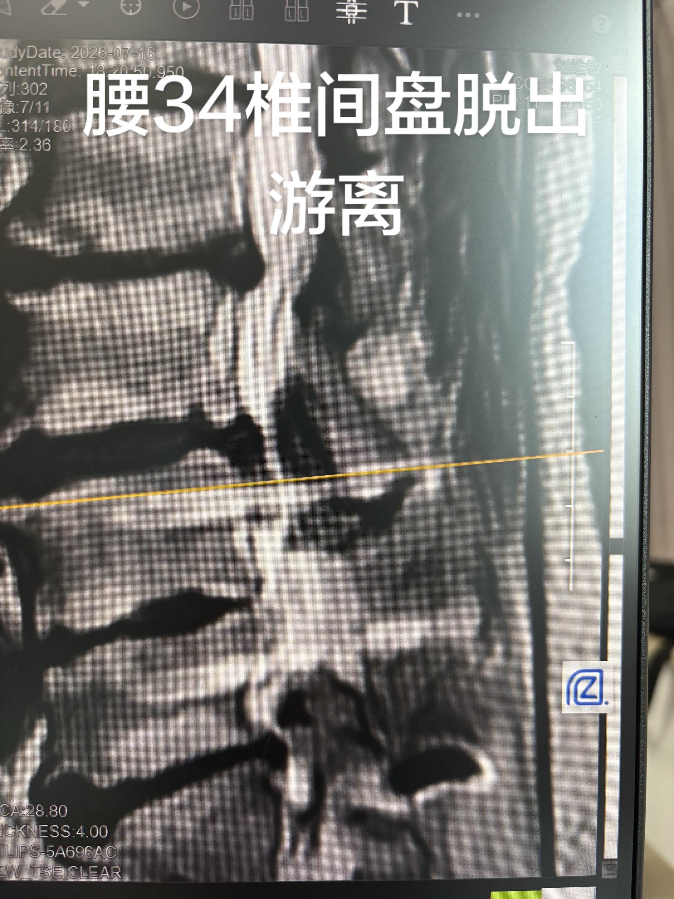 邻椎病巧用微创手术处理。邻椎病的发生原因众多，这位老太太体型非常肥胖...