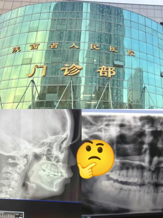 西安牙齿矫正挖到宝，公立主任只要1w5❓