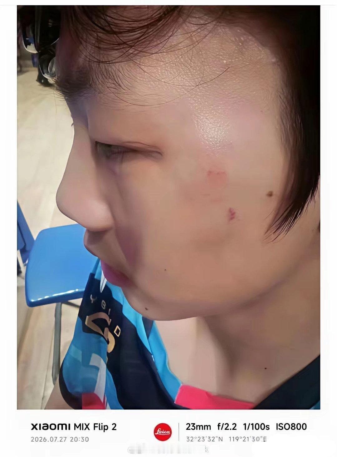 看这孩子被打的，只是赢了比赛脸都被对手拳头打青了，可怜🥺输球了不至于打人吧，还
