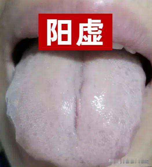 舌面有裂纹，也要分阴阳，千万别瞎补，中医教你怎么区分！

一：阳虚——裂纹舌

