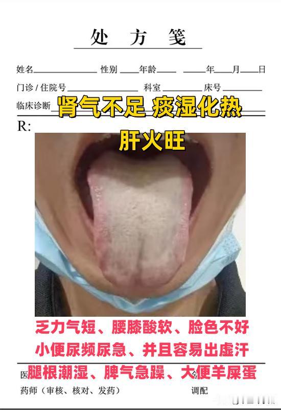 舌诊挑战案例分析：
1、肾气不足，痰湿化热 ，肝火旺
2、痰湿化热，有心火，脾虚