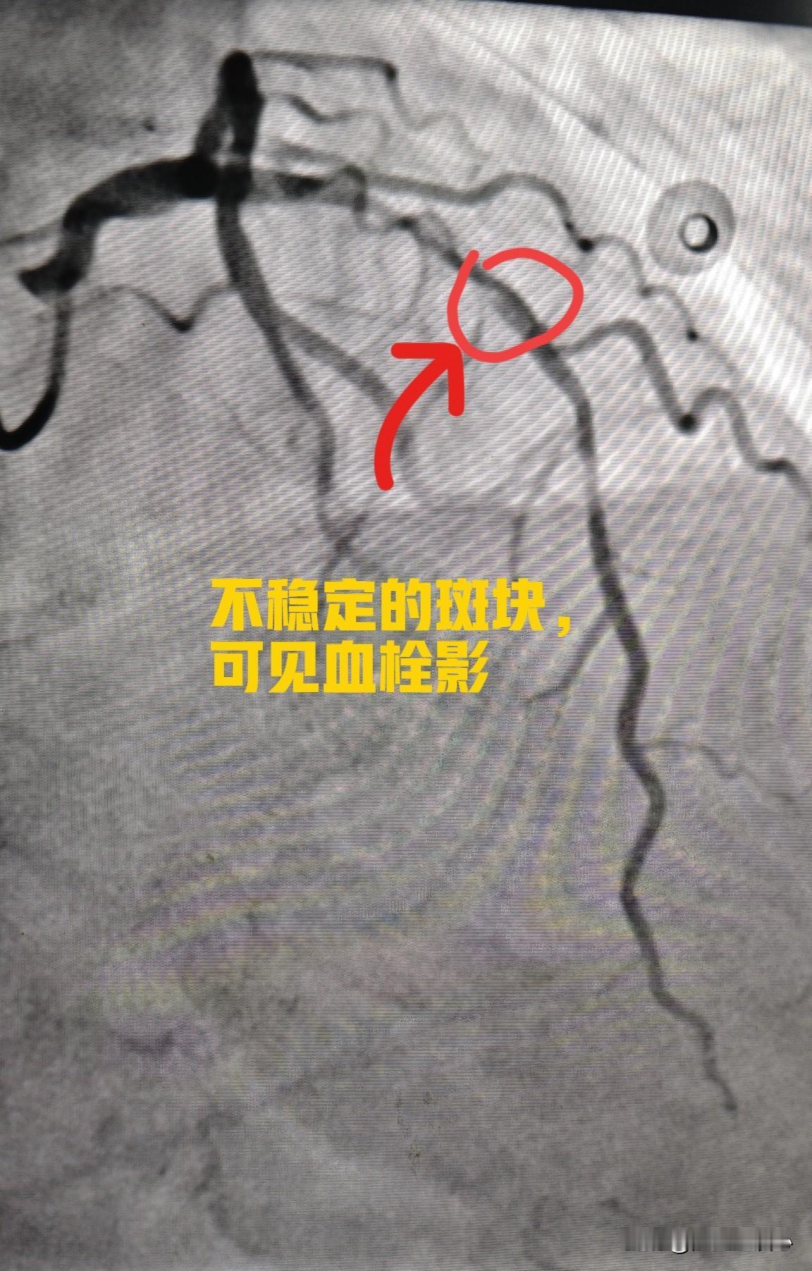 来看看心脏血管斑块破裂是什么样子的。一个 75 岁的男性患者，在医院就诊时，突发
