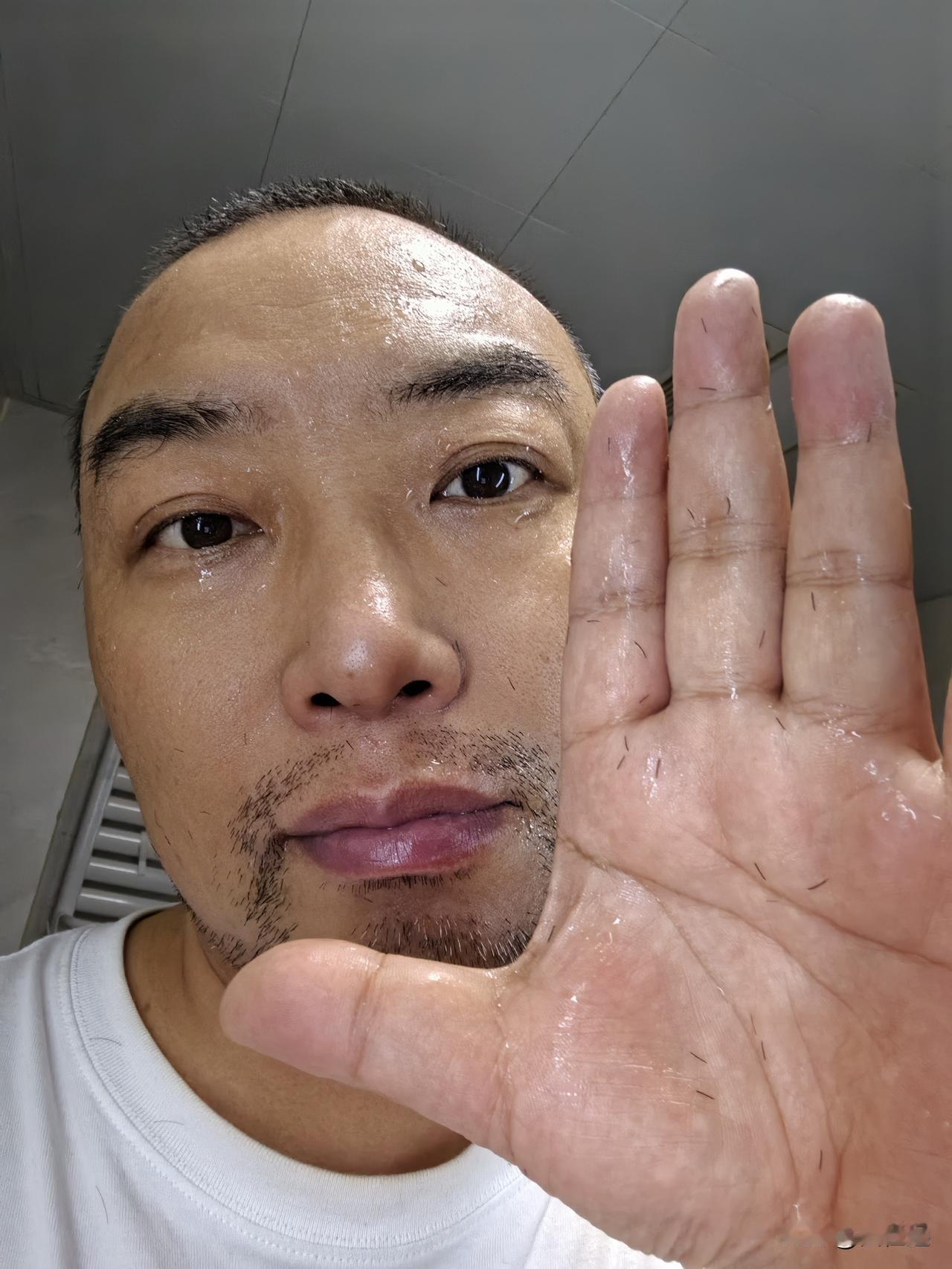 肺癌晚期，第37次化疗结束19天。
竟然开始掉胡子了。

这次化疗因为换了药，从