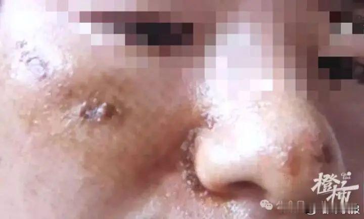 男子信偏方不洗脸成