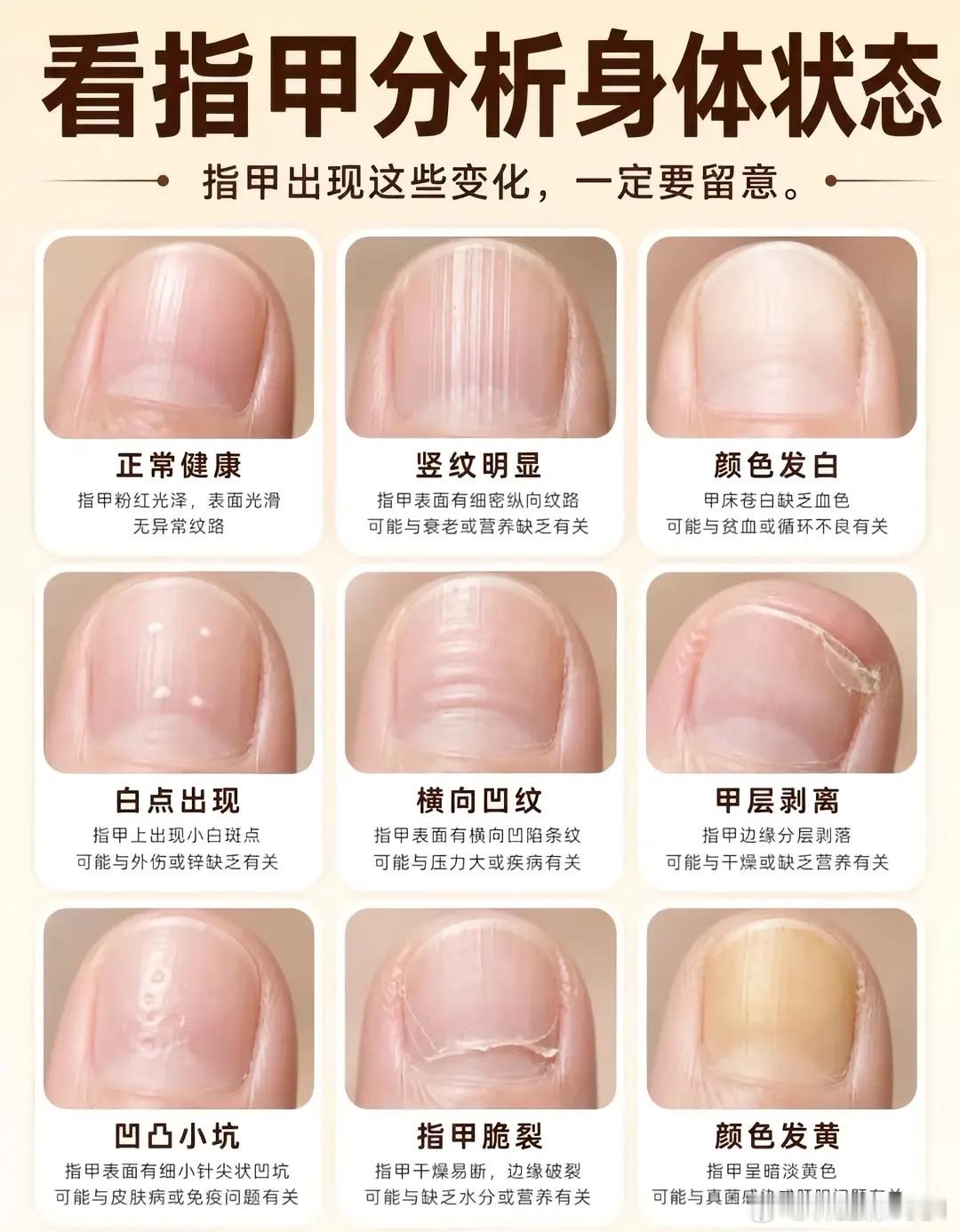 看指甲分析身体状态 ​​​