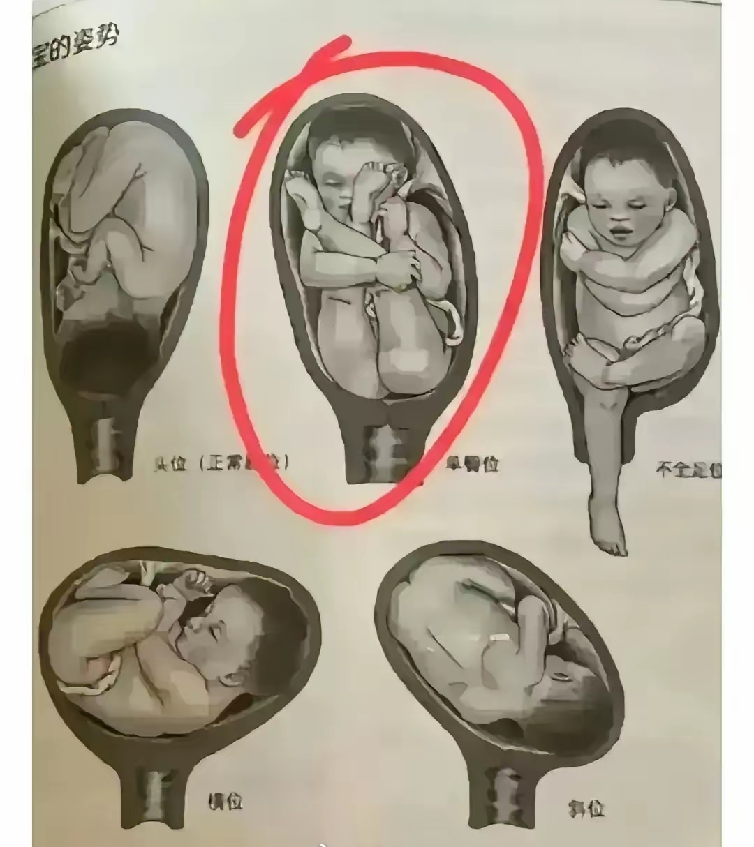 图二胎位放古代，九死一生吧？ 