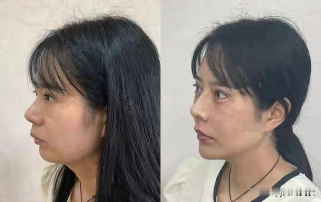 吉林长春50岁女子打除皱针被老板加量，半个月后不幸身亡，家属索赔121万，法院判