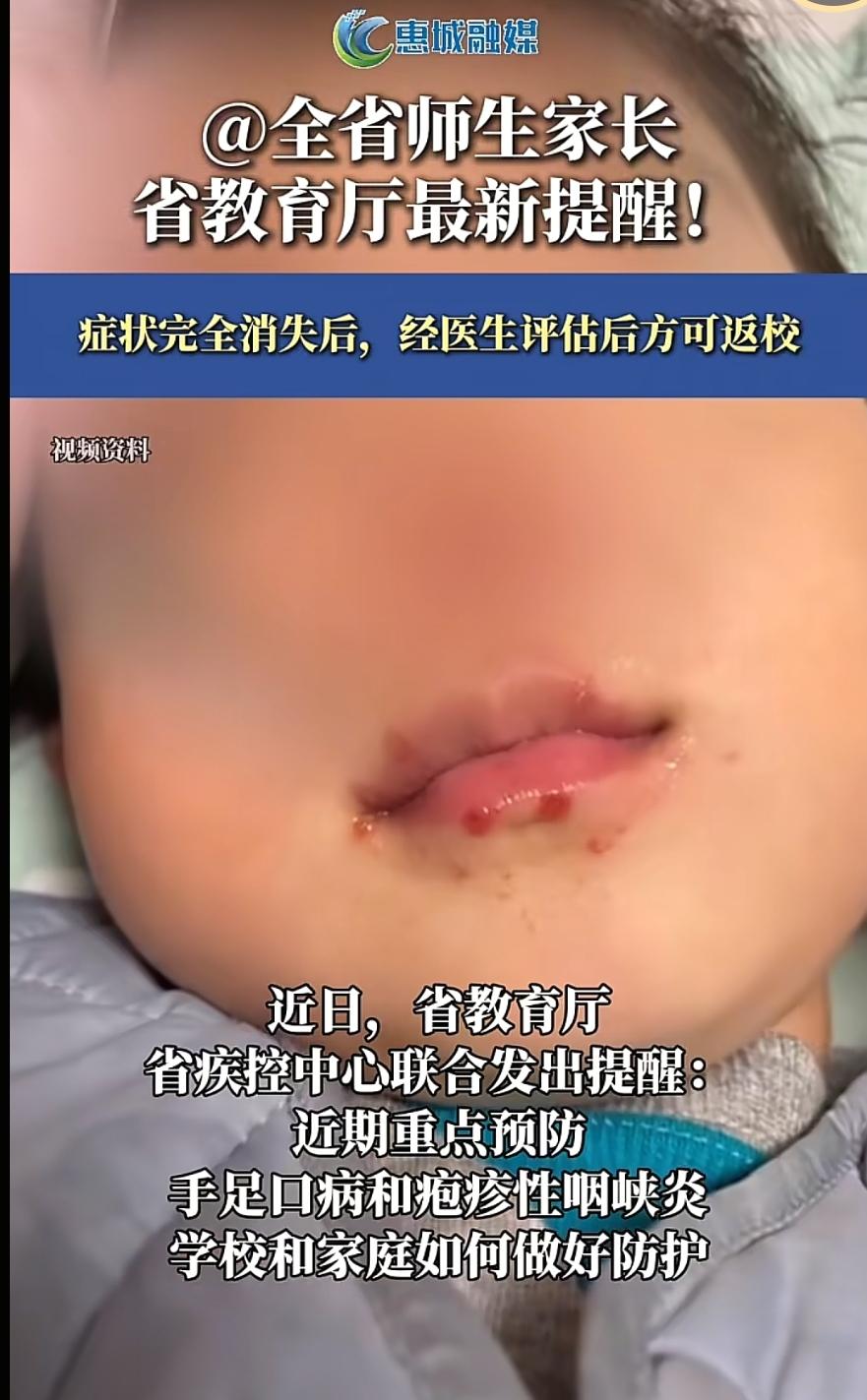 广东近期手足口病集中暴发，班级直接停课十天，家长一定要做好防护
 
广东近期气温