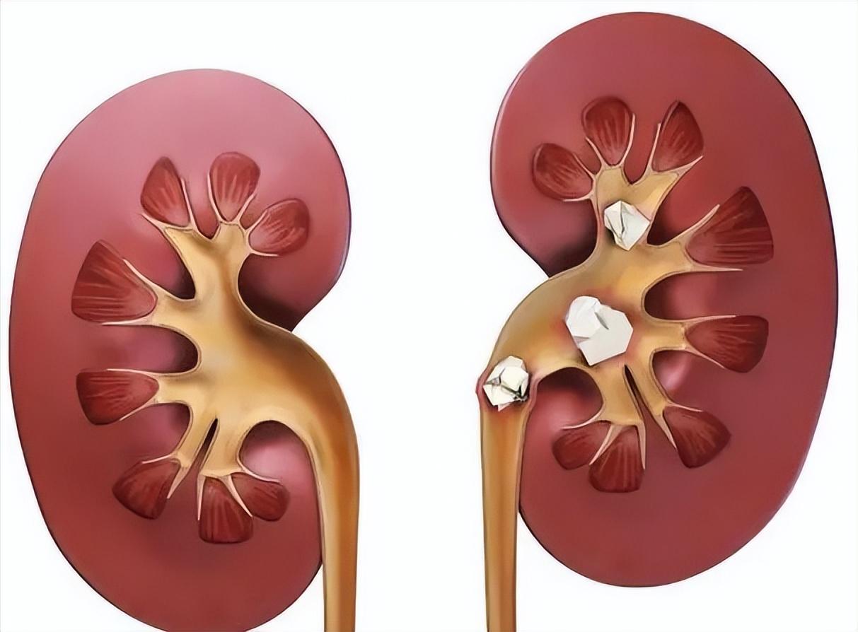 中医：通过这3个穴位有效缓解“肾结石”的症状，来看看是哪3个！

“这痛苦简直无