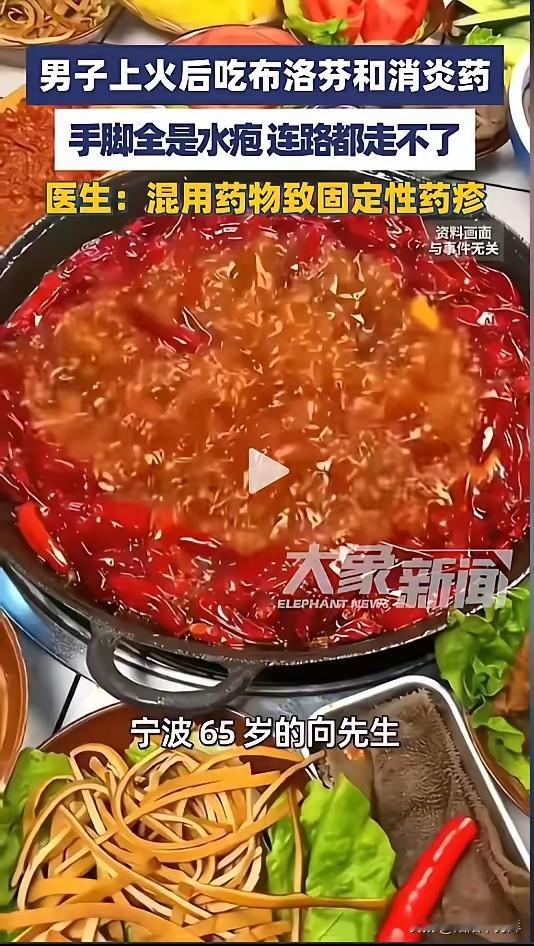 “悲剧还是发生了！”近日，浙江宁波，一男子因为连续吃火锅后开始牙疼，就吃了点布洛