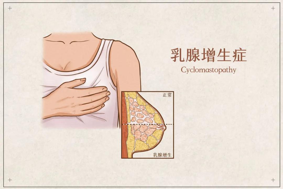 #健康真探社#【为什么乳腺增生的女性越来越多？】乳腺增生是一种正常的生理现象，不
