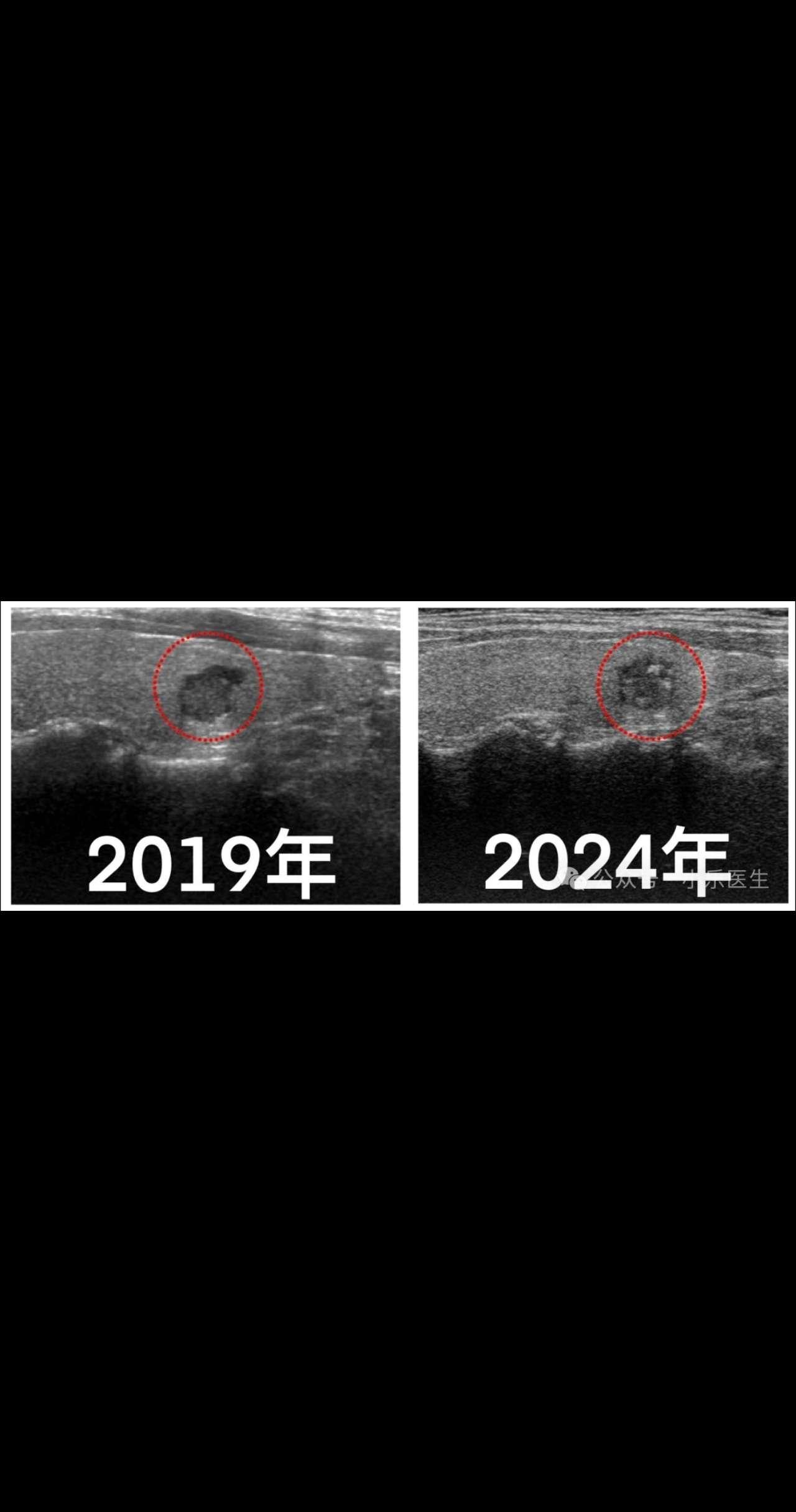 甲状腺癌是懒癌么？图1图2都是甲状腺乳头状癌。 图1病灶5年都没有变化...