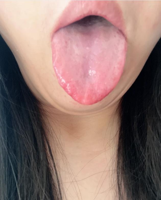 六味地黄丸的舌象！
这一位女士，身体上部特别热，动不动就上火
从腰部开始往下是凉