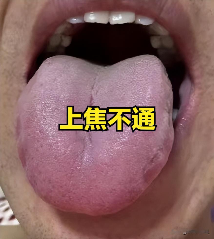 上焦不通失眠多梦，中焦不通腹胀胃胀，下焦不通功能减退，何医生教你舌头看三焦，找对